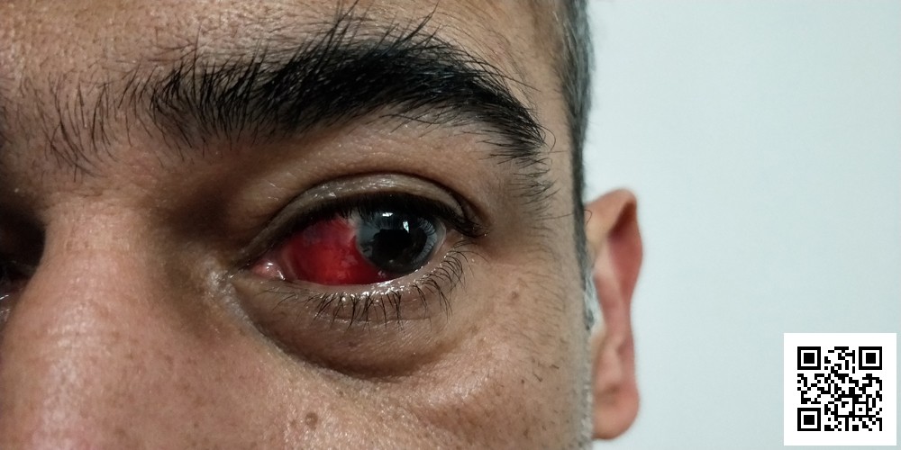 A Broken Blood Vessel in Your Eye What You Can Do Dialect Zone