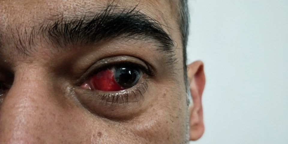A Broken Blood Vessel In Your Eye What You Can Do Dialect Zone International